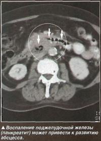 Воспаление поджелудочной железы