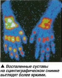 Воспаленные суставы на сцинтиграфическом снимке выглядят более яркими