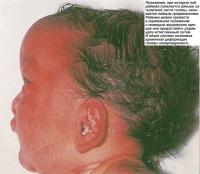 Возможна временная деформация головы новорожденного