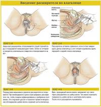 Введение расширителя во влагалище
