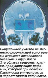 Выделенный участок на магнитно-резонансной томограмме отражает локализацию базальных ядер мозга