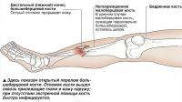 Здесь показан открытый перелом большеберцовой кости