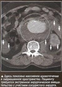 Здесь показано массивное кровотечение в забрюшинное пространство
