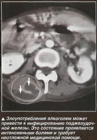 Злоупотребление алкоголем может привести к инфицированию поджелудочной железы