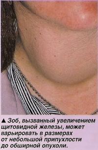 Зоб, вызванный увеличением щитовидной железы